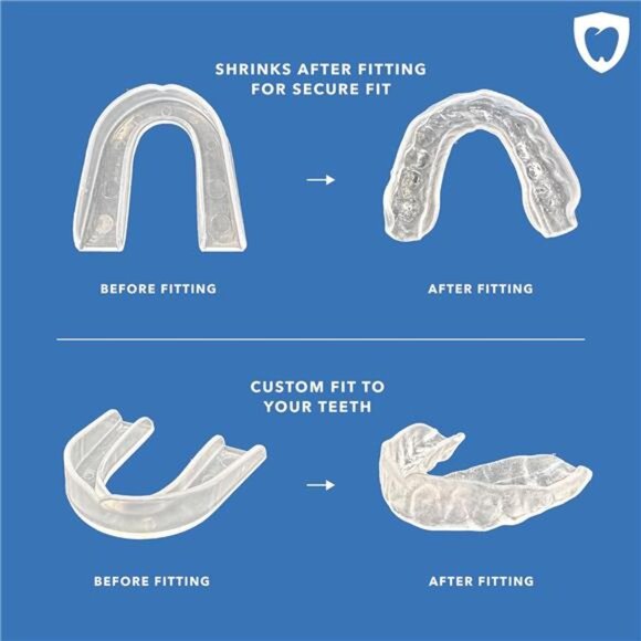 Zero-Grind Nightguard - Custom Fit Night Guard for Teeth Grinding - Picture 3 of 6